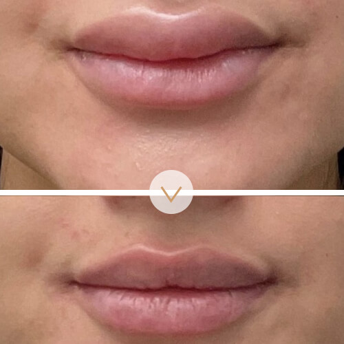1- Filler Overcorrection Reduction (1)