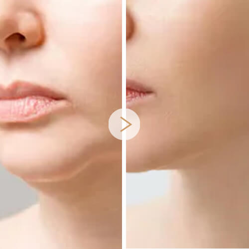 4-Targeted Filler Correction (1)