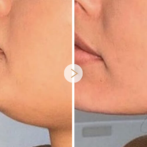 6-Overall Skin Rejuvenation (1)